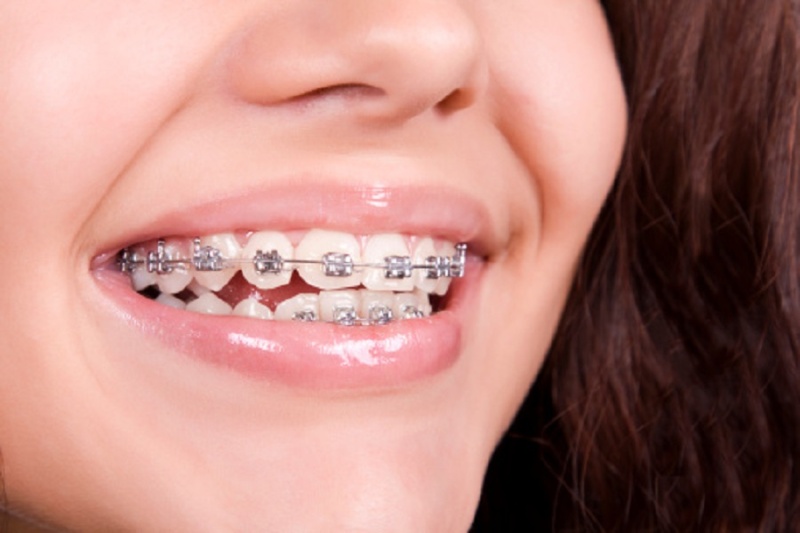 Des consultations orthodontiques